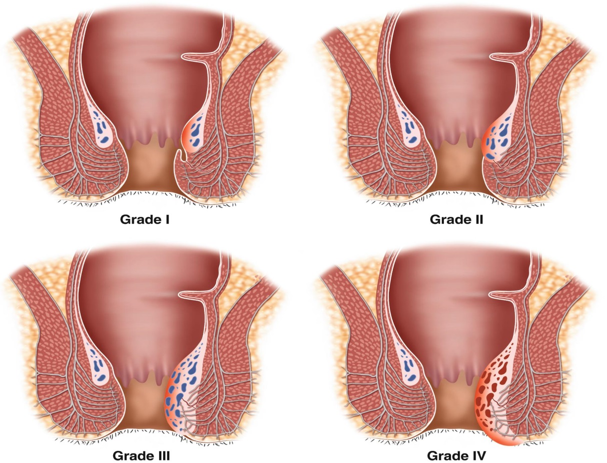Grades of internal hemorrhoid prolapse