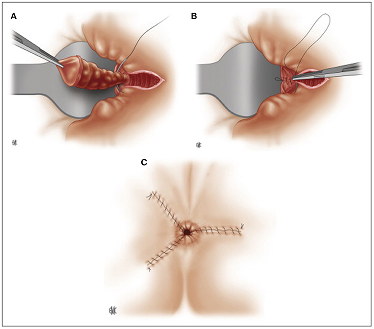 Hemorrhoidectomy surgical removal of hemorrhoids