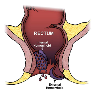 Internal and external hemorrhoids medical diagram