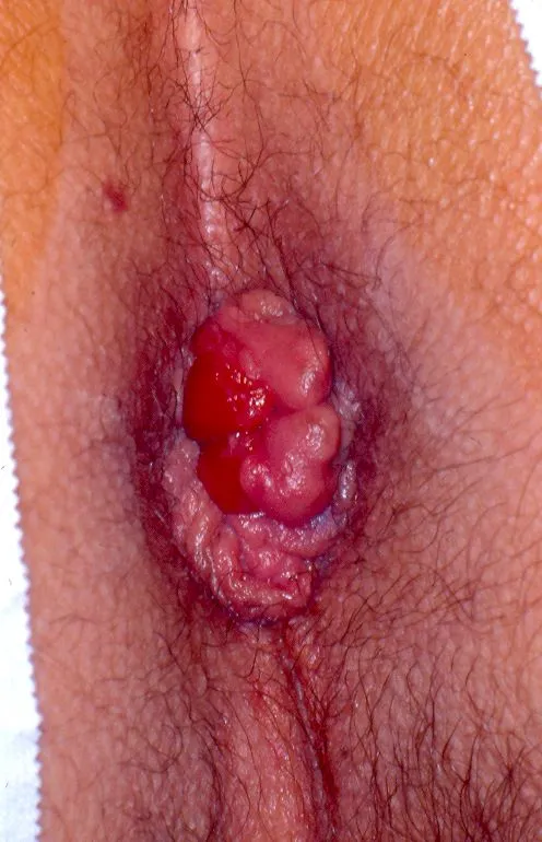 Real picture of fourth degree prolapsed hemorrhoid