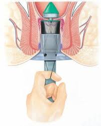 Stapled hemorrhoidopexy procedure for prolapsing internal hemorrhoids