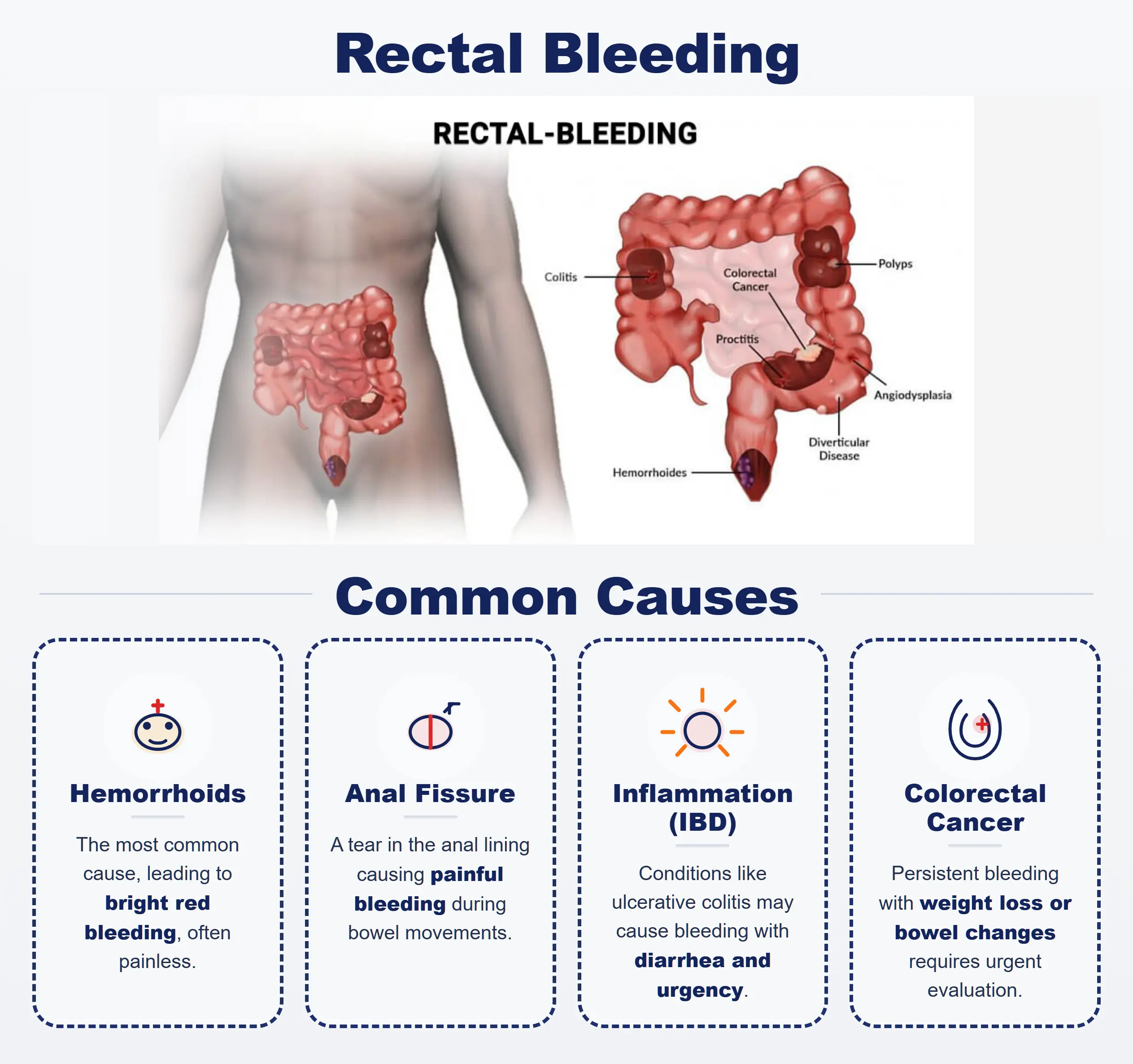 Rectal Bleeding FAQ | Questions About Rectal Bleeding