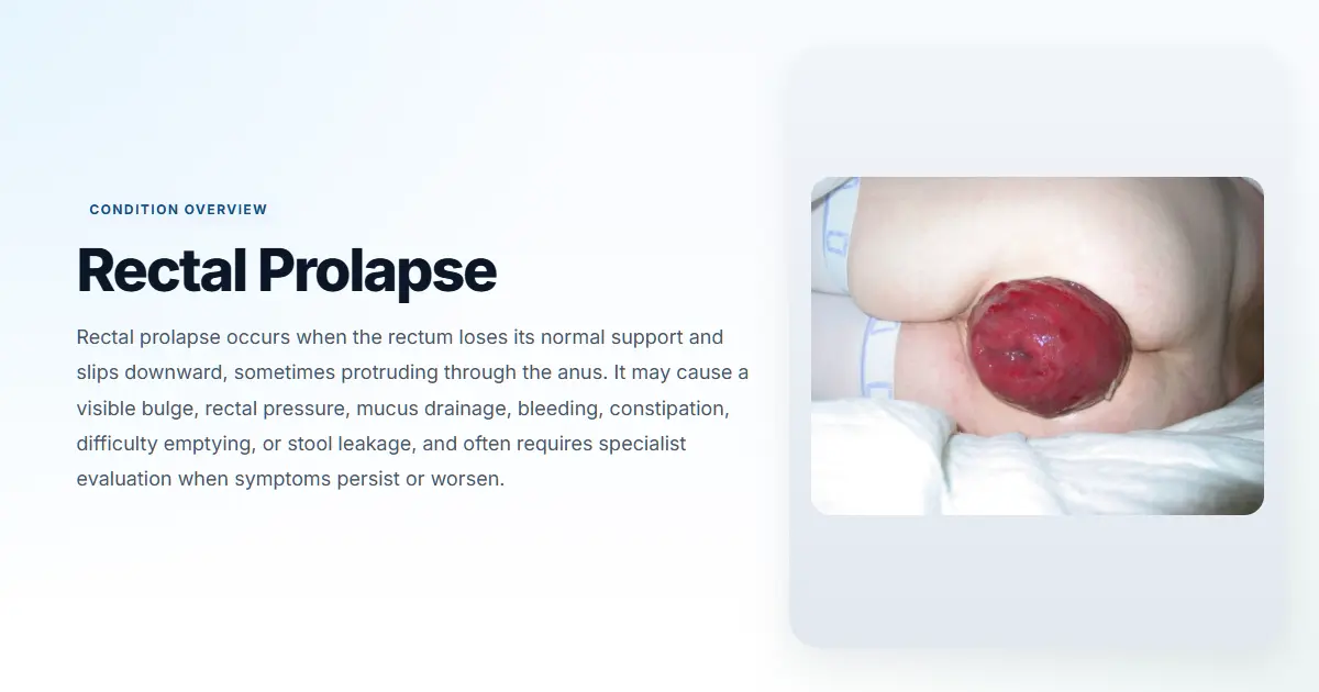 Rectal Prolapse FAQ | Questions About Rectal Prolapse