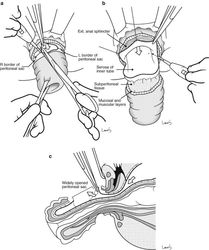 Medical illustration showing perineal rectosigmoidectomy as a surgical treatment for rectal prolapse