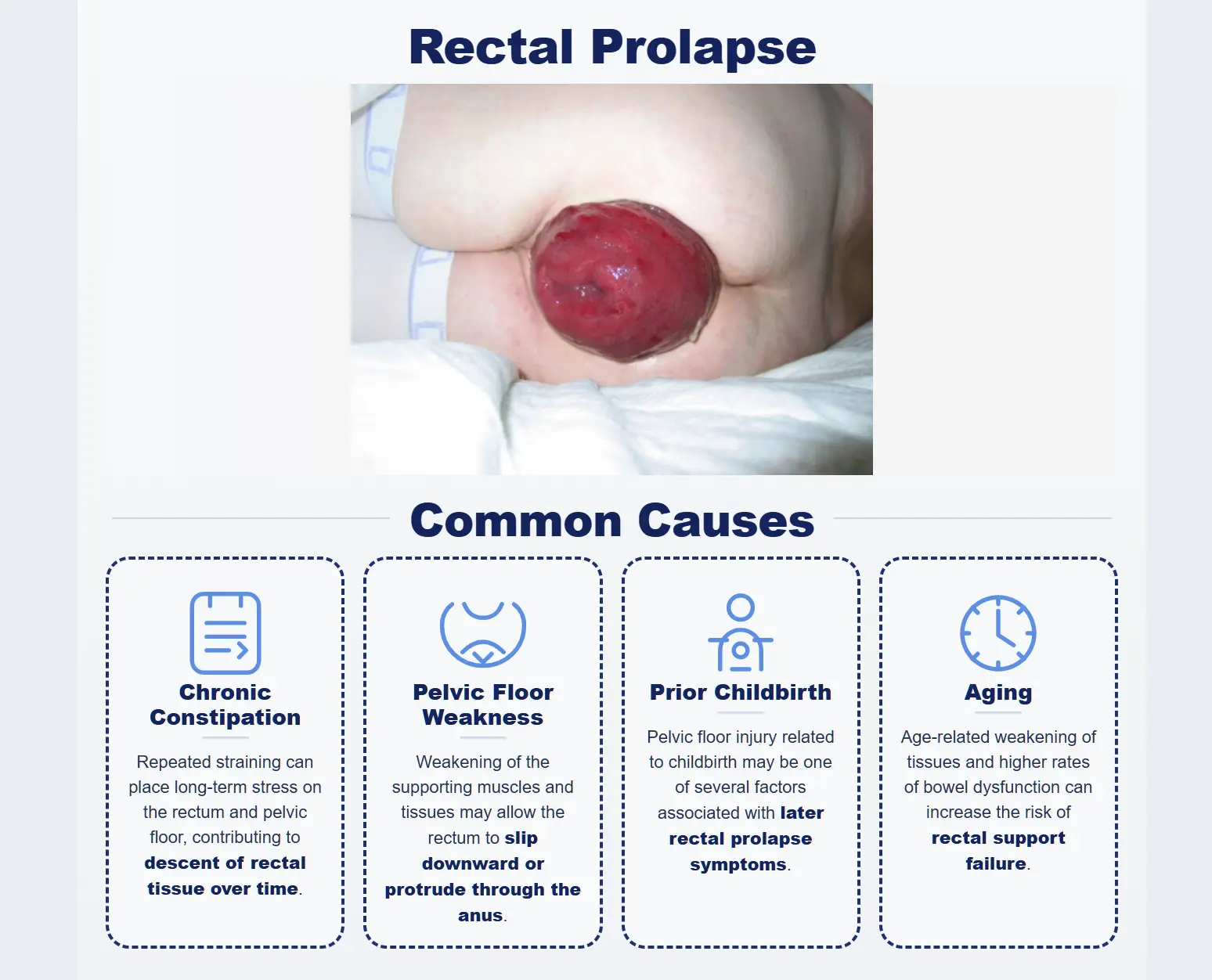 Medical illustration showing common symptoms of rectal prolapse including tissue protrusion, bleeding, mucus drainage, and constipation