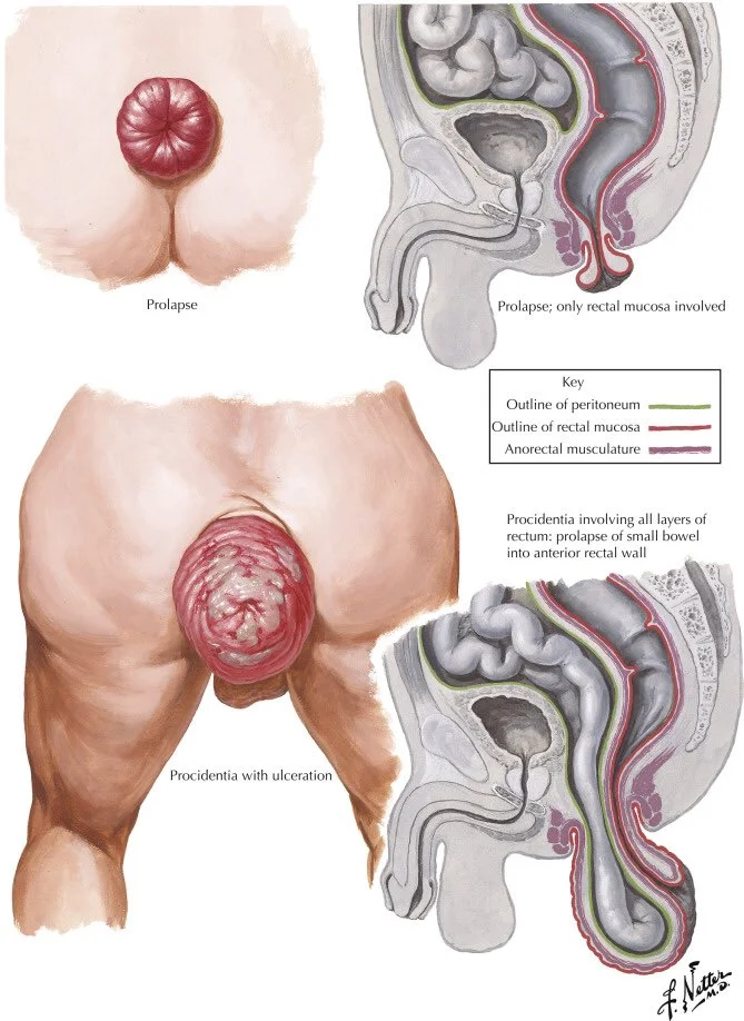 Medical illustration showing rectal prolapse and supporting anorectal anatomy