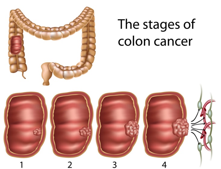 Ilustración médica que muestra las etapas del cáncer de colon desde enfermedad temprana hasta diseminación avanzada