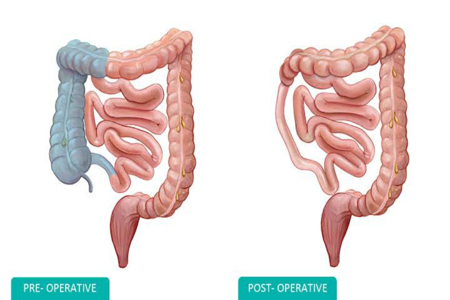 Diagrama preoperatorio y posoperatorio de hemicolectomía derecha que muestra la extirpación del colon derecho para cirugía de cáncer de colon del lado derecho