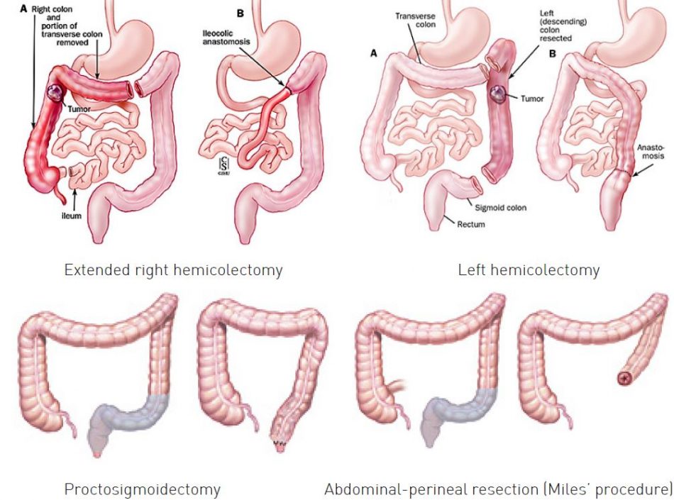 Diagramas de cirugía de cáncer de colon que muestran hemicolectomía derecha extendida, hemicolectomía izquierda, proctosigmoidectomía y resección abdominoperineal