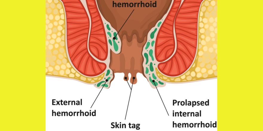Diagram showing anal skin tag between an external hemorrhoid and a prolapsed internal hemorrhoid near the anal opening