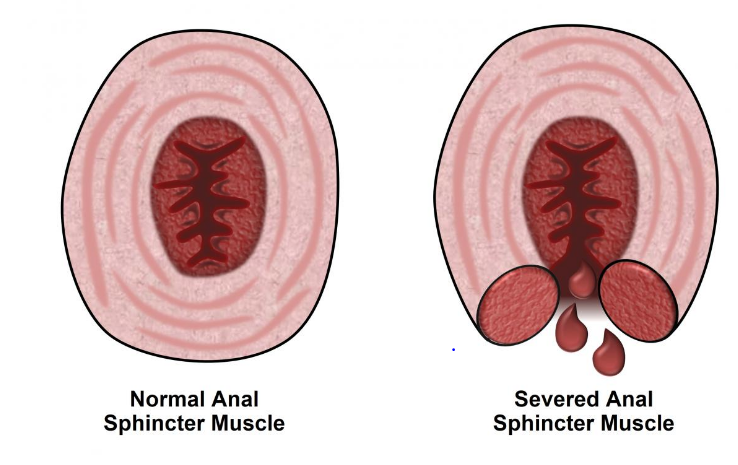 Anatomy associated with normal bowel control and fecal incontinence