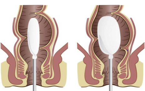 Anorectal testing used during the evaluation of fecal incontinence