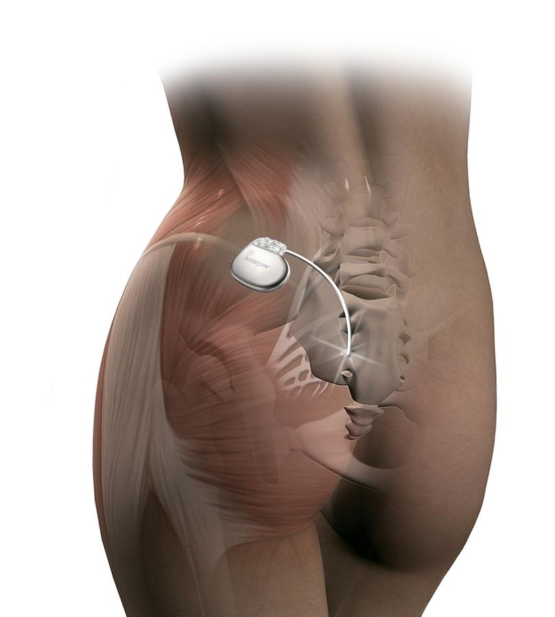 Sacral nerve stimulation for fecal incontinence